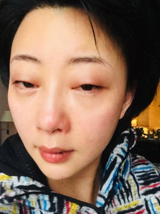 肿眼明星,揭秘娱乐圈中的“美丽”秘密